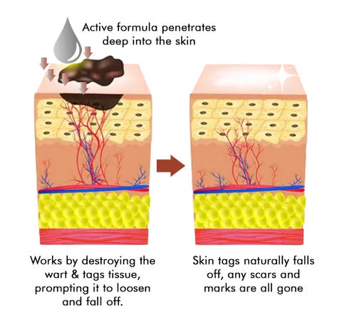 Tags & Moles Remover (Buy 1 Get 1 Free🔥🔥)